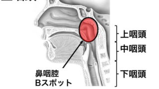 慢性上咽頭炎と頭痛の関係
