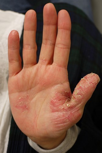 掌蹠膿疱症の手のひら（治療前）