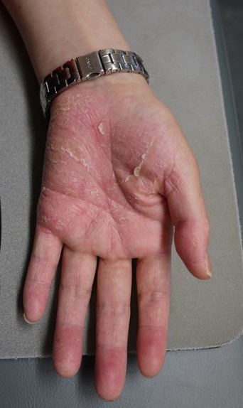 50歳代女性の掌蹠膿疱症の手のひら（治療前）