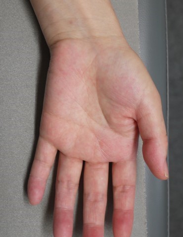 50歳代女性の掌蹠膿疱症の手のひら（治療後）