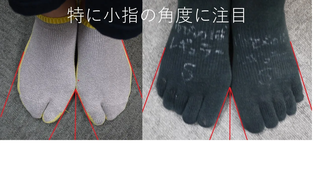 医師解説】足袋型ソックスの弱点【内反小趾にご用心】 - 福岡のみらい 