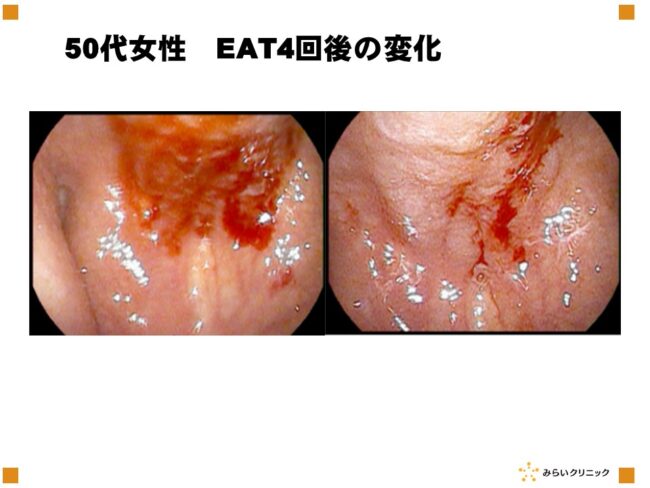 上咽頭炎の評価
