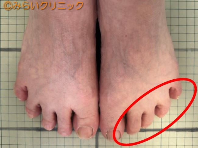 足指の変形が膝痛の原因!? 正座が楽になる足指のケア法 | 福岡のみらい
